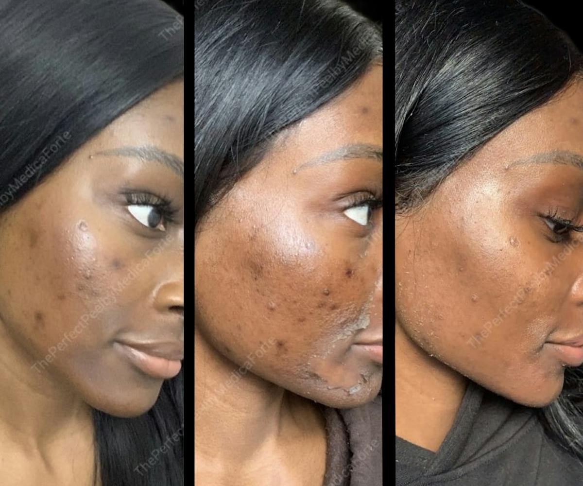 Chemical Peels Before & After Gallery - Patient 383812 - Image 1