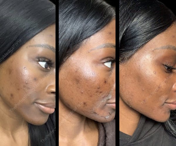 Chemical Peels Before & After Gallery - Patient 383812 - Image 1