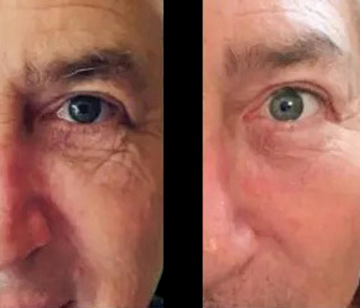 Chemical Peels Before & After Gallery - Patient 805837 - Image 1