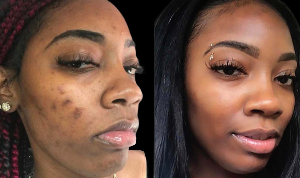 Chemical Peels Before & After Gallery - Patient 396208 - Image 1