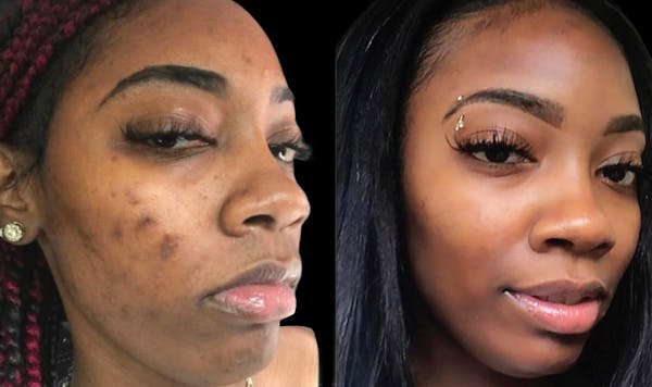 Chemical Peels Before & After Gallery - Patient 396208 - Image 1