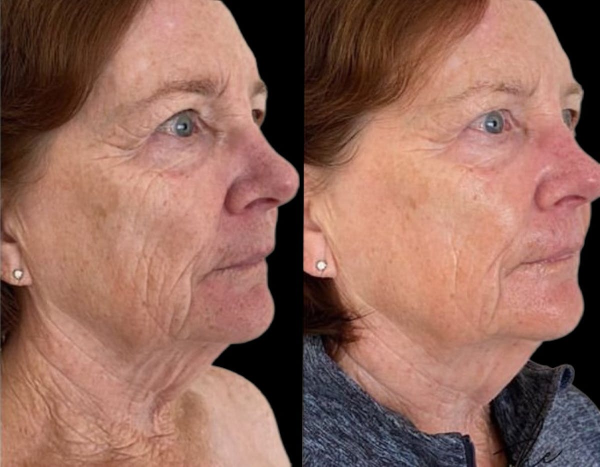 CO2 Lift Pro Mask Before & After Gallery - Patient 366637 - Image 1