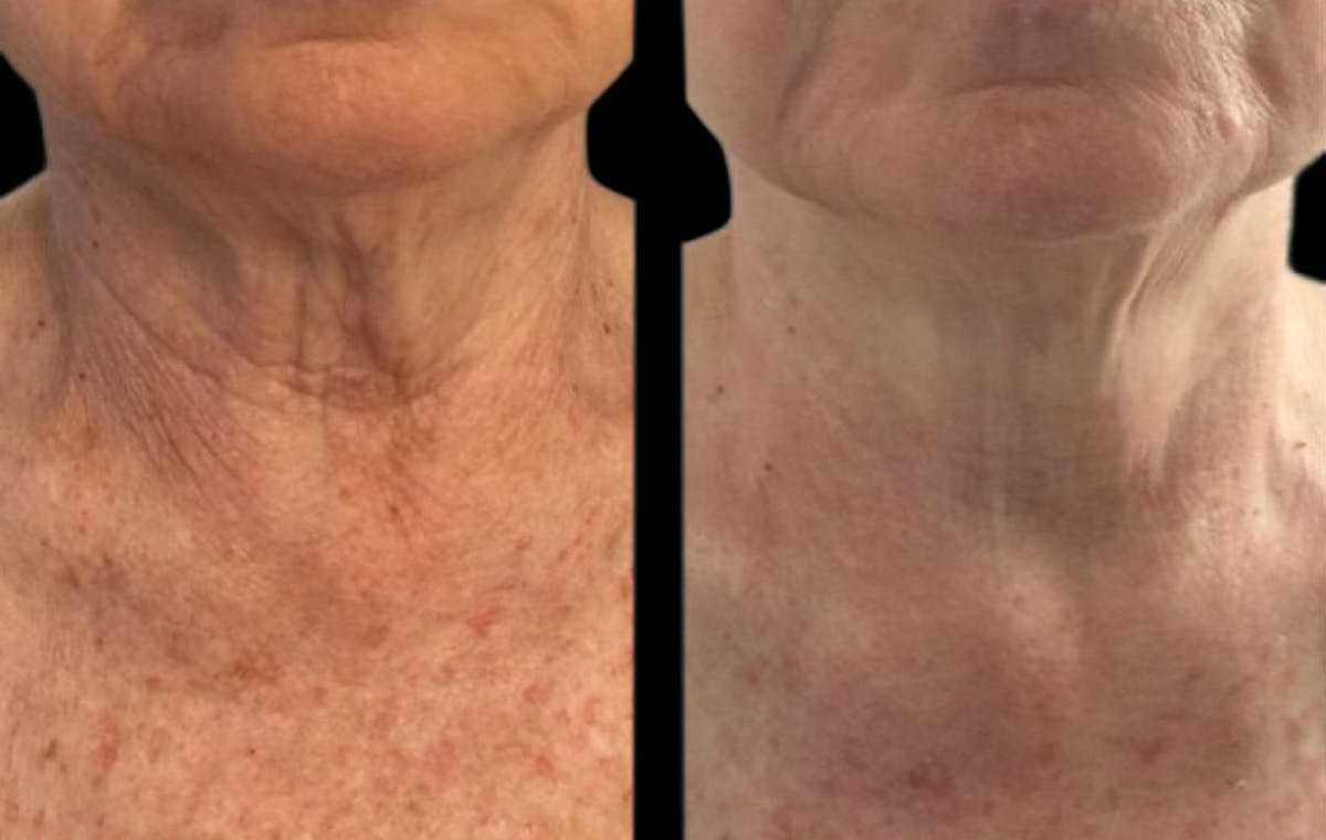 CO2 Lift Pro Mask Before & After Gallery - Patient 685803 - Image 1