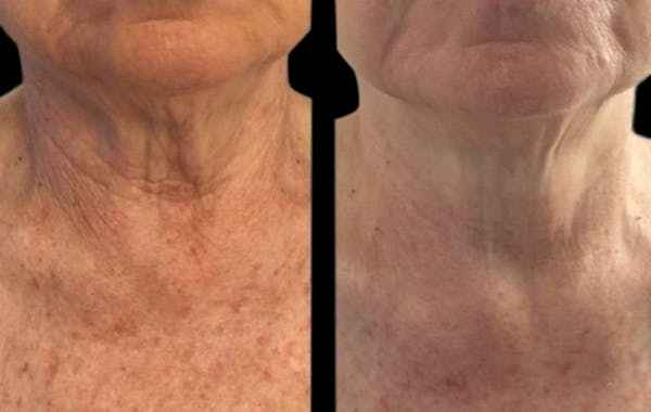 CO2 Lift Pro Mask Before & After Gallery - Patient 685803 - Image 1