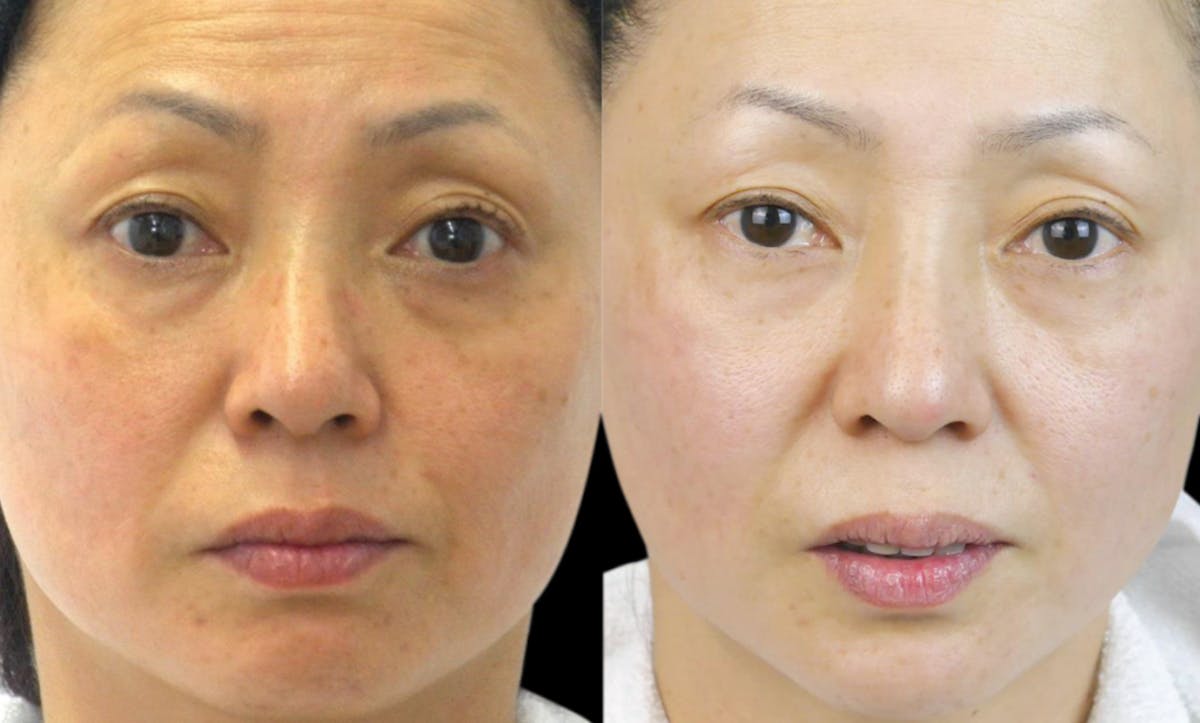 CO2 Lift Pro Mask Before & After Gallery - Patient 932512 - Image 1