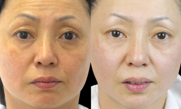 CO2 Lift Pro Mask Before & After Gallery - Patient 932512 - Image 1
