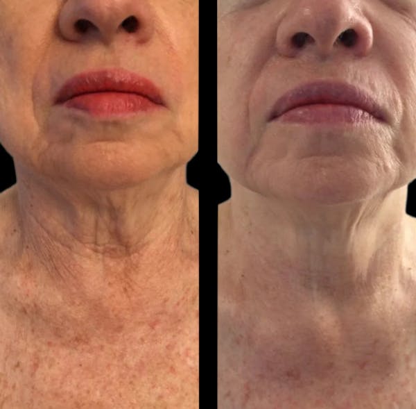 CO2 Lift Pro Mask Before & After Gallery - Patient 384152 - Image 1