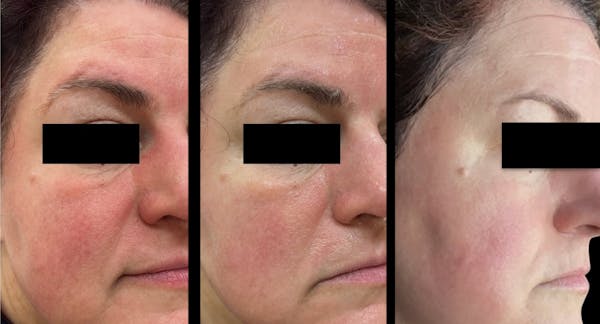 CO2 Lift Pro Mask Before & After Gallery - Patient 288422 - Image 1
