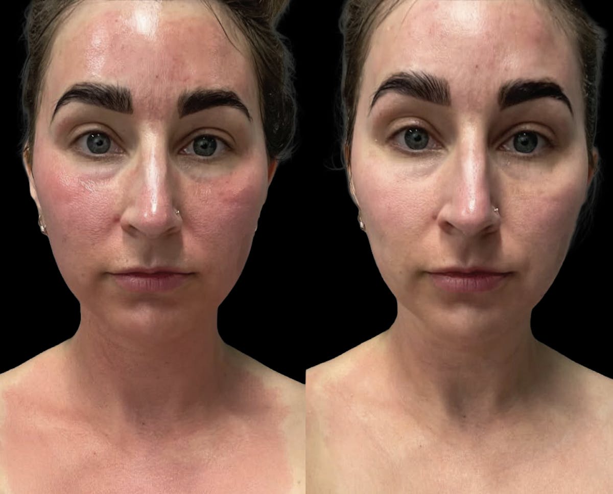 CO2 Lift Pro Mask Before & After Gallery - Patient 662541 - Image 1