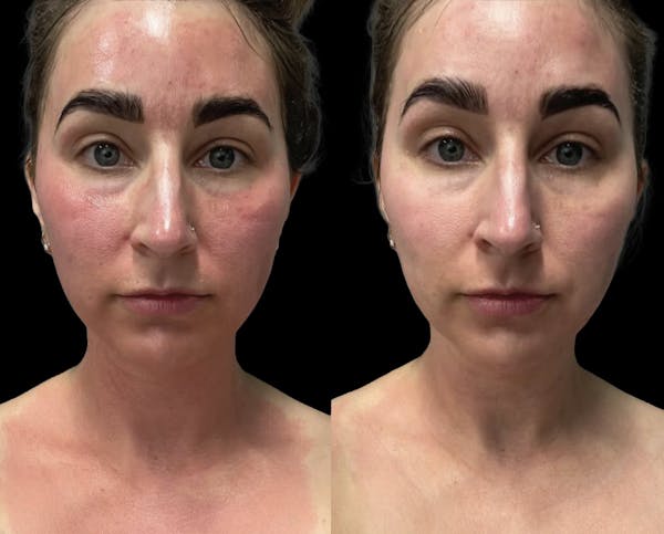 CO2 Lift Pro Mask Before & After Gallery - Patient 662541 - Image 1