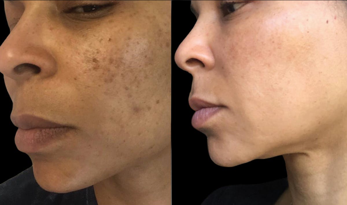 CO2 Lift Pro Mask Before & After Gallery - Patient 914782 - Image 1