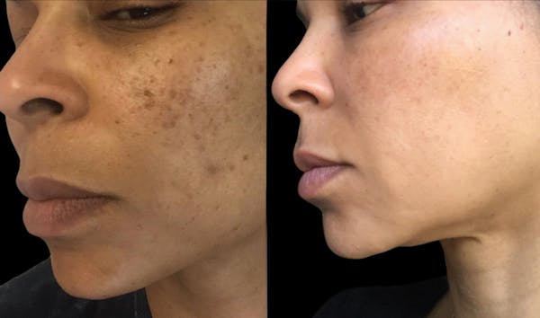 CO2 Lift Pro Mask Before & After Gallery - Patient 914782 - Image 1