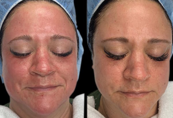 CO2 Lift Pro Mask Before & After Gallery - Patient 285005 - Image 1