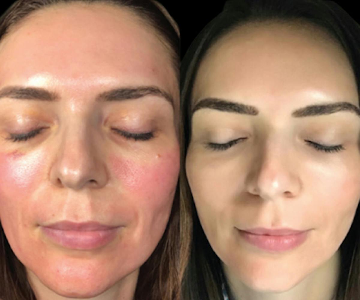 CO2 Lift Pro Mask Before & After Gallery - Patient 412987 - Image 1