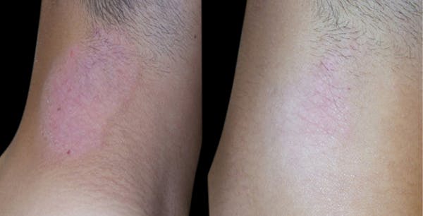 CO2 Lift Pro Mask Before & After Gallery - Patient 116700 - Image 1