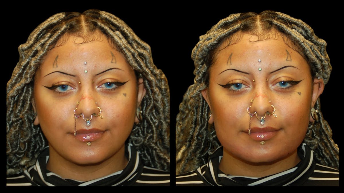 Dermal Filler Before & After Gallery - Patient 165261 - Image 2