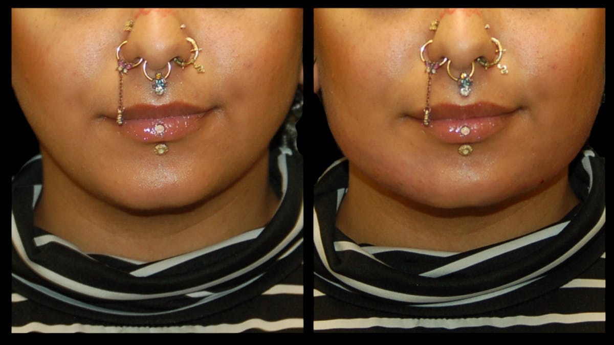 Dermal Filler Before & After Gallery - Patient 165261 - Image 3