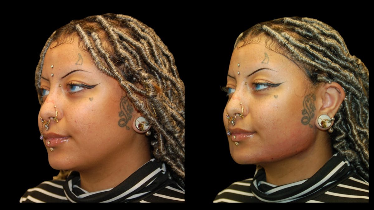 Dermal Filler Before & After Gallery - Patient 165261 - Image 1