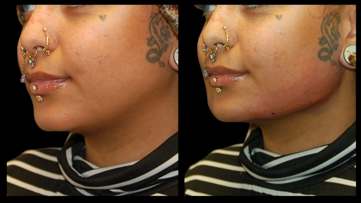 Dermal Filler Before & After Gallery - Patient 165261 - Image 4