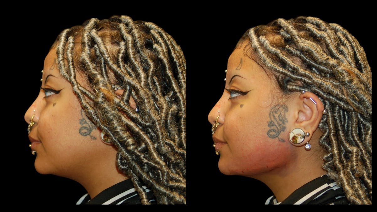 Dermal Filler Before & After Gallery - Patient 165261 - Image 5