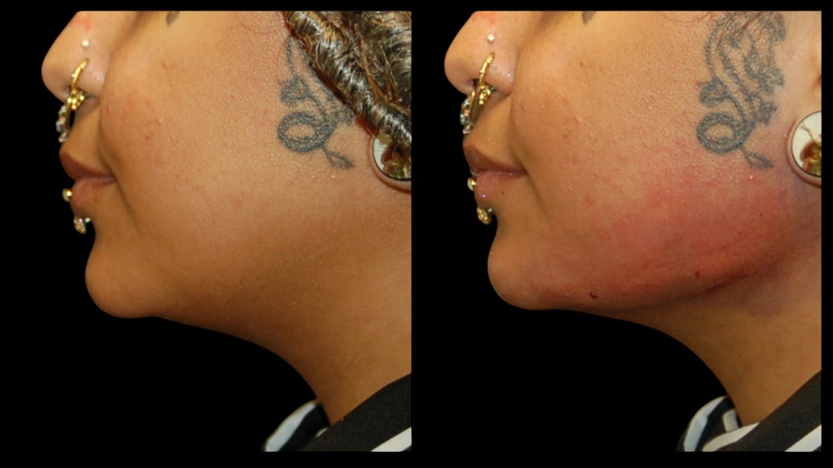 Dermal Filler Before & After Gallery - Patient 165261 - Image 6