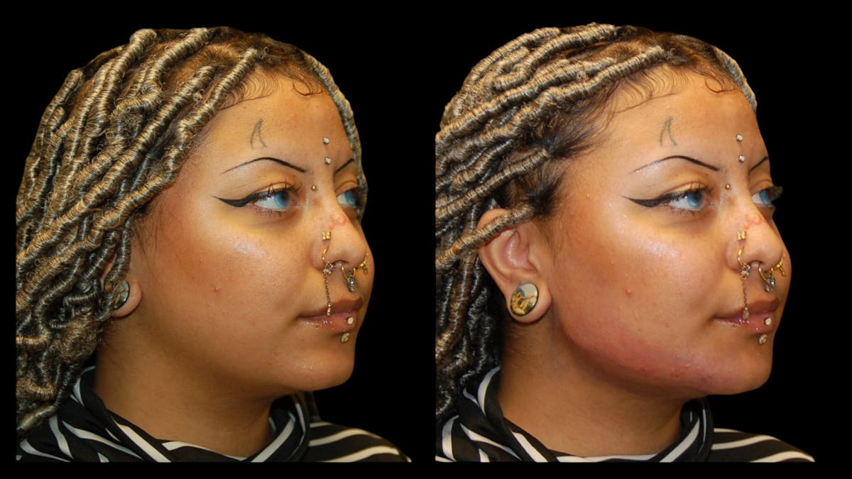 Dermal Filler Before & After Gallery - Patient 165261 - Image 7