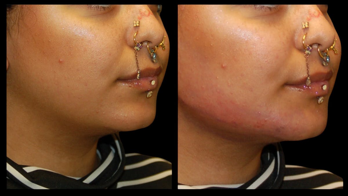 Dermal Filler Before & After Gallery - Patient 165261 - Image 8
