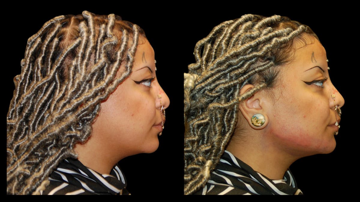 Dermal Filler Before & After Gallery - Patient 165261 - Image 9