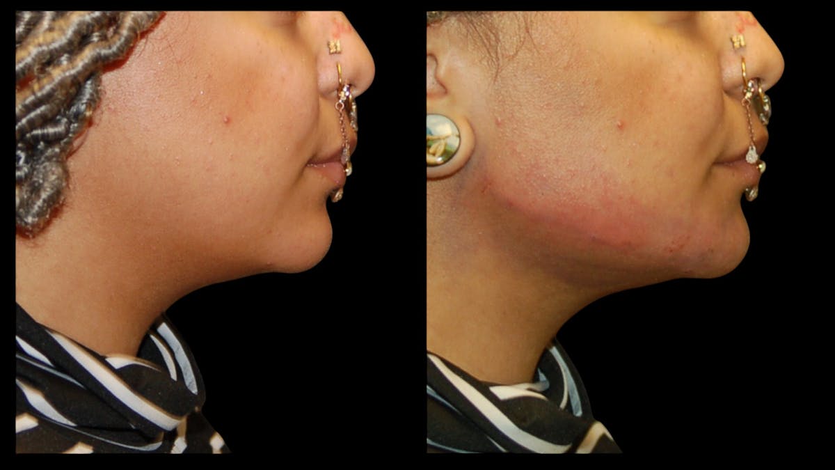 Dermal Filler Before & After Gallery - Patient 165261 - Image 10