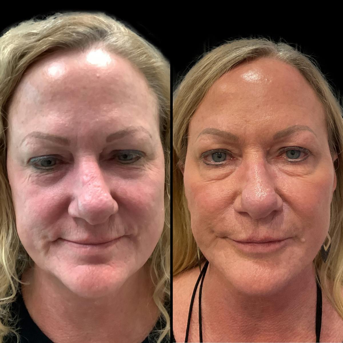 Dermal Filler Before & After Gallery - Patient 118724 - Image 1