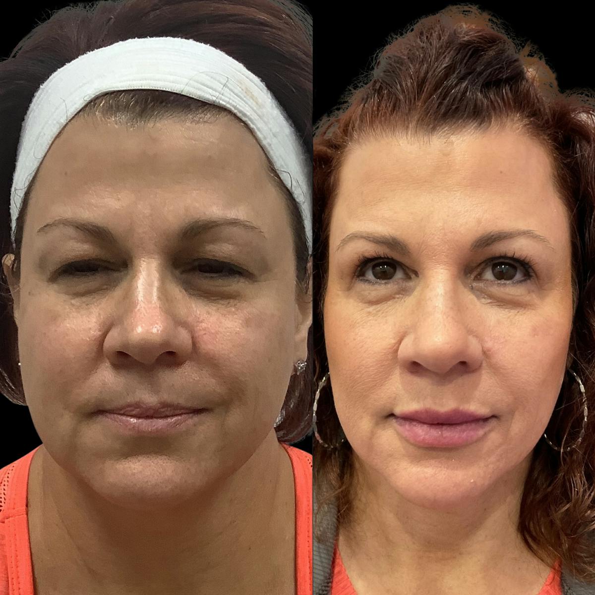 Dermal Filler Before & After Gallery - Patient 335279 - Image 1