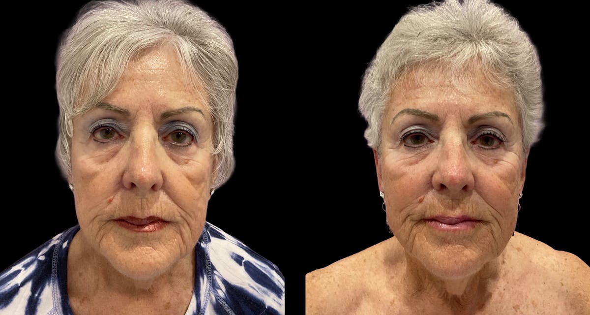 Facial Contouring Before & After Gallery - Patient 121090 - Image 3