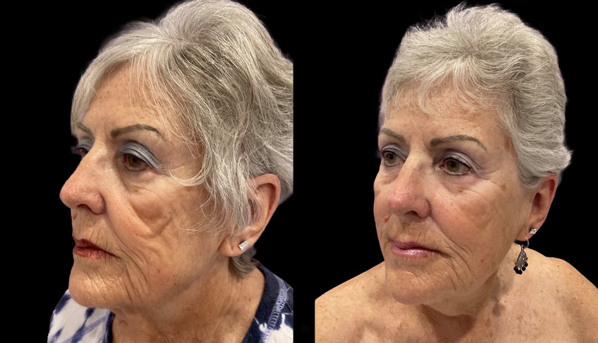Facial Contouring Before & After Gallery - Patient 121090 - Image 2