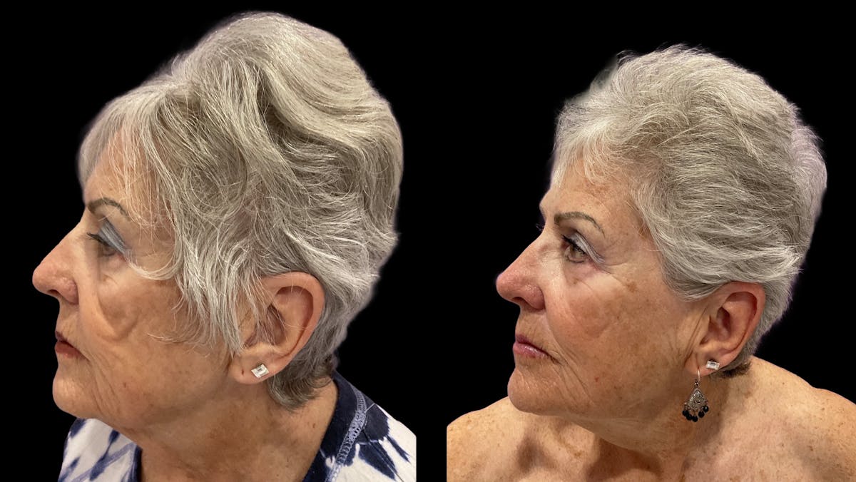 Facial Contouring Before & After Gallery - Patient 121090 - Image 1
