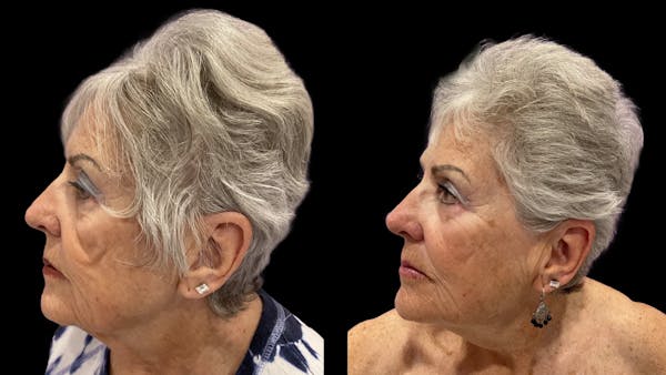 Facial Contouring Before & After Gallery - Patient 121090 - Image 1