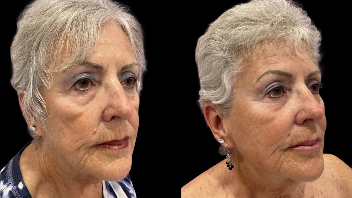 Facial Contouring Before & After Gallery - Patient 121090 - Image 4