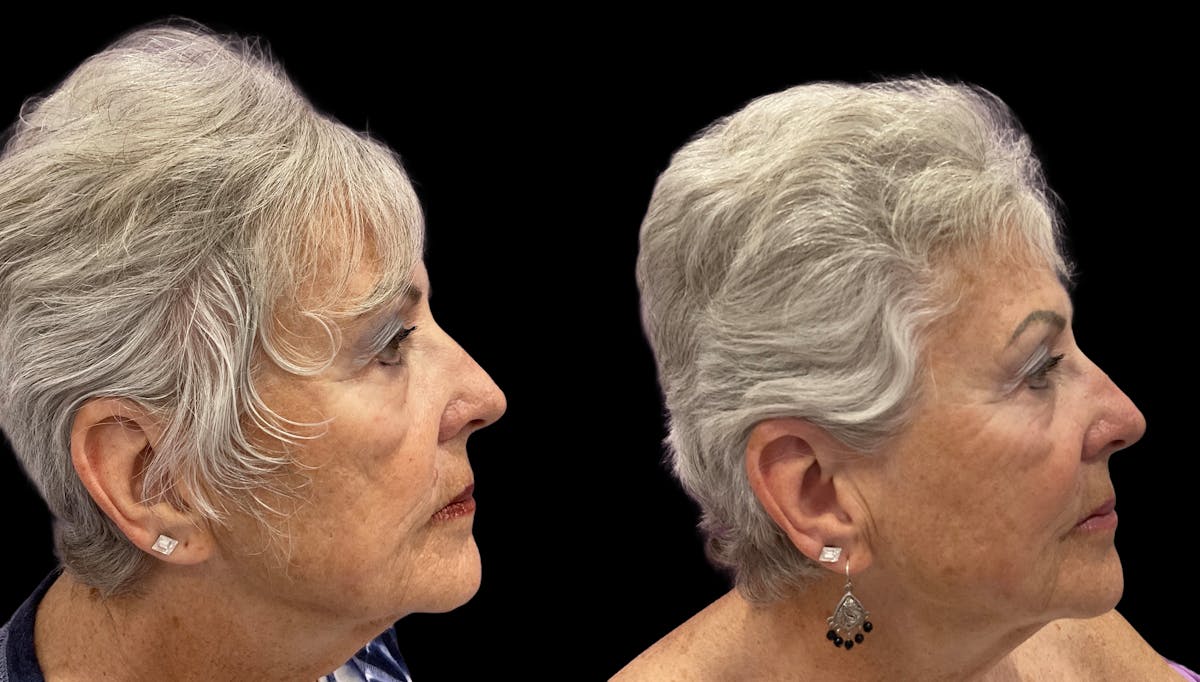 Facial Contouring Before & After Gallery - Patient 121090 - Image 5