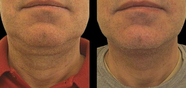 Facial Contouring Before & After Gallery - Patient 149429 - Image 1