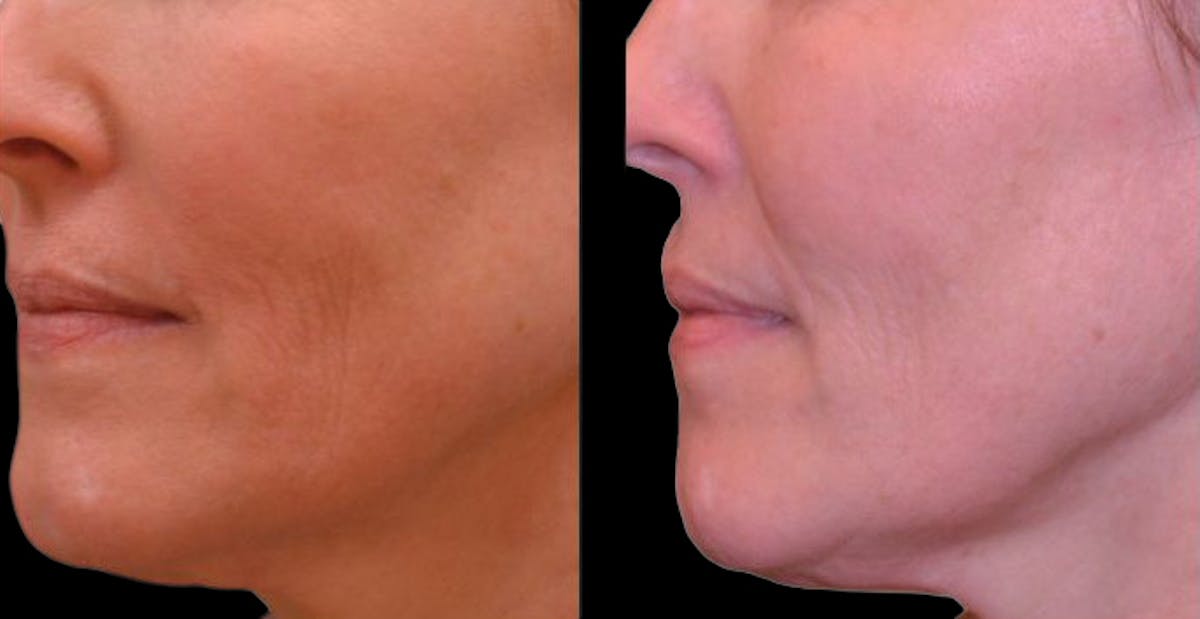 Facial Contouring Before & After Gallery - Patient 354663 - Image 1
