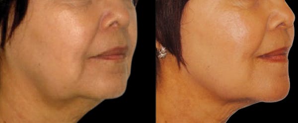 Facial Contouring Before & After Gallery - Patient 118976 - Image 1