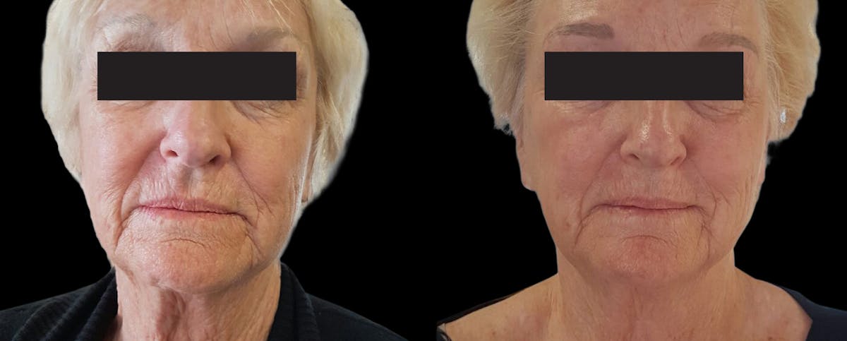 Facial Contouring Before & After Gallery - Patient 104812 - Image 1