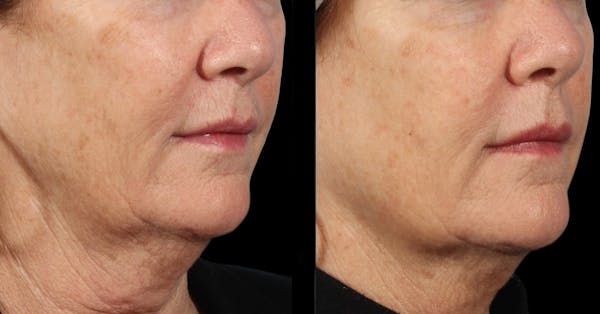 Facial Contouring Before & After Gallery - Patient 210322 - Image 1