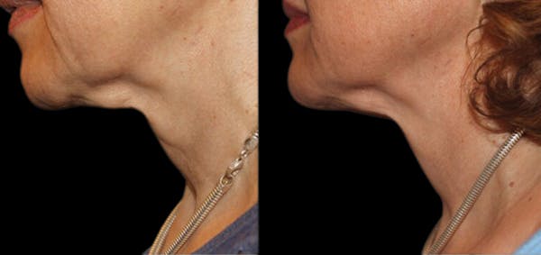 Facial Contouring Before & After Gallery - Patient 267395 - Image 1