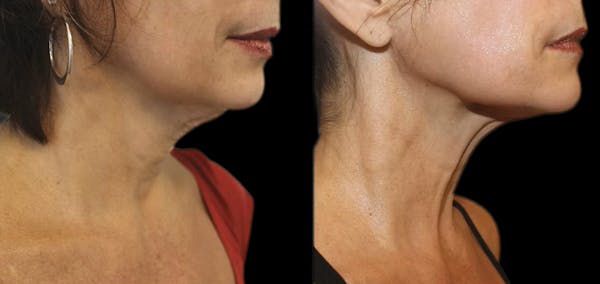 Facial Contouring Before & After Gallery - Patient 672547 - Image 1