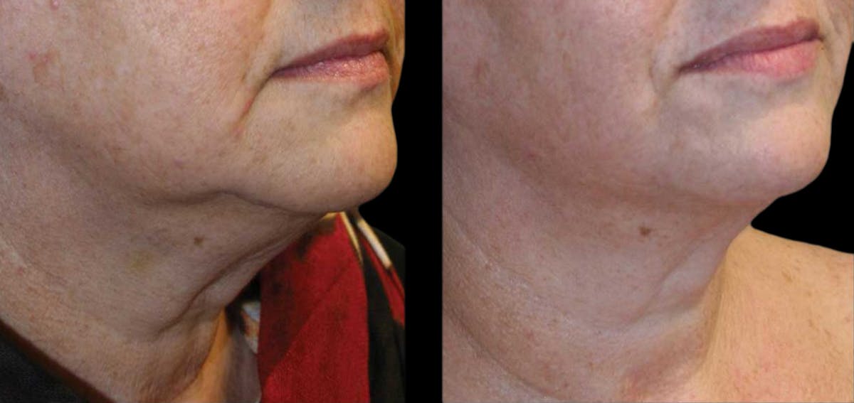 Facial Contouring Before & After Gallery - Patient 163460 - Image 1