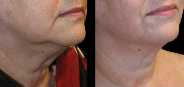 Facial Contouring Before & After Gallery - Patient 163460 - Image 1