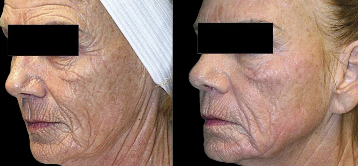 Facial Contouring Before & After Gallery - Patient 835614 - Image 1