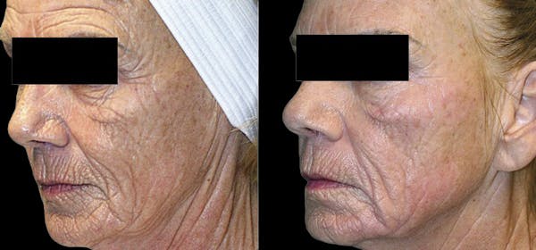 Facial Contouring Before & After Gallery - Patient 835614 - Image 1