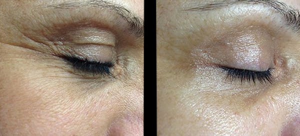 Geneo Before & After Gallery - Patient 227875 - Image 1