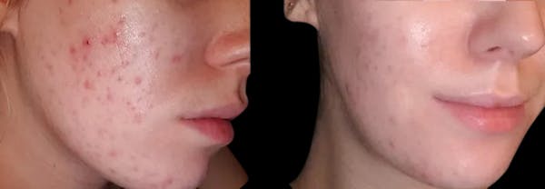 Geneo Before & After Gallery - Patient 298691 - Image 1